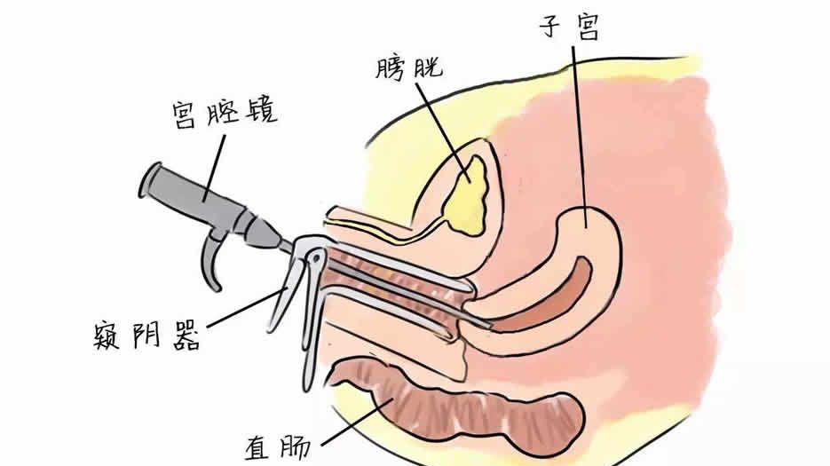 宫腔镜疗法