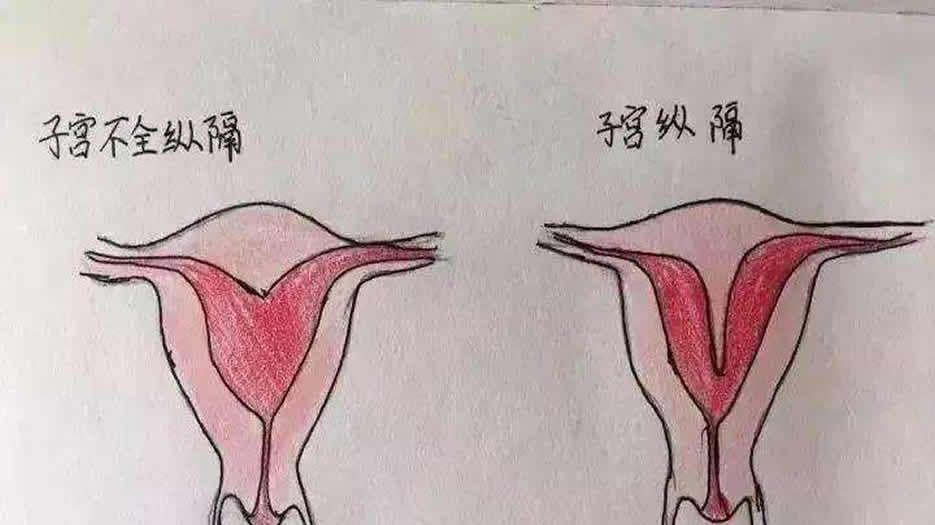 纵膈子宫