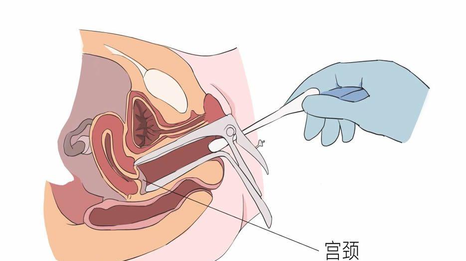 治疗弓形子宫
