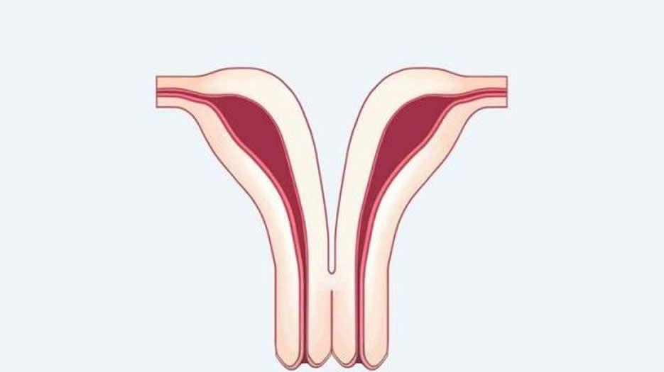 纵隔子宫