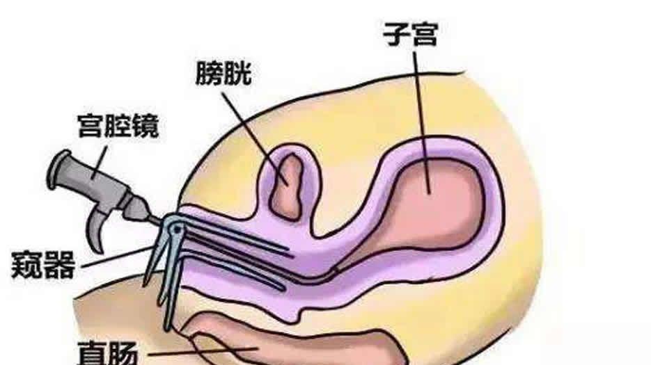 宫腔镜联合腹腔镜微创手术治疗