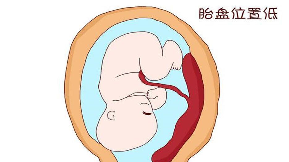 引起不良妊娠