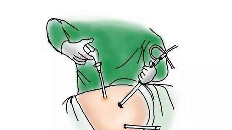 腹腔镜手术