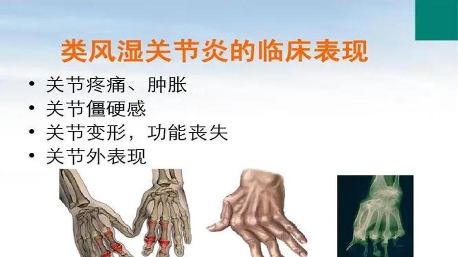 类风湿关节炎的症状表现