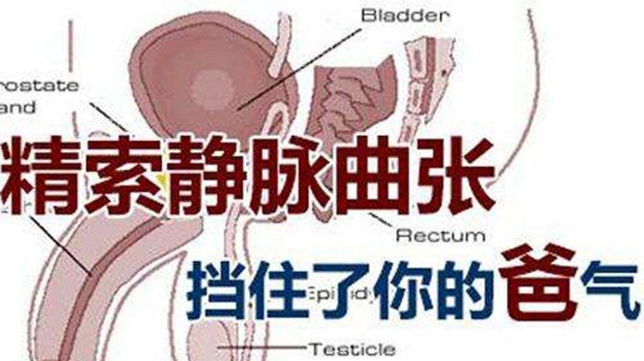 什么是精索静脉曲张