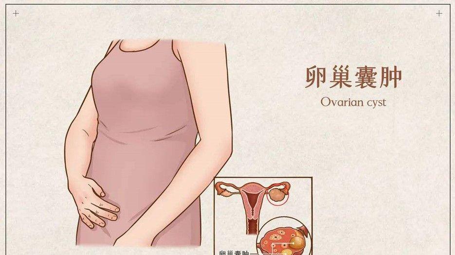 卵巢囊肿名词科普