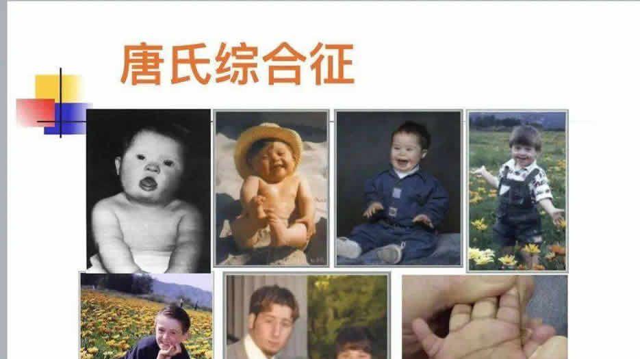 唐氏综合症.jpg