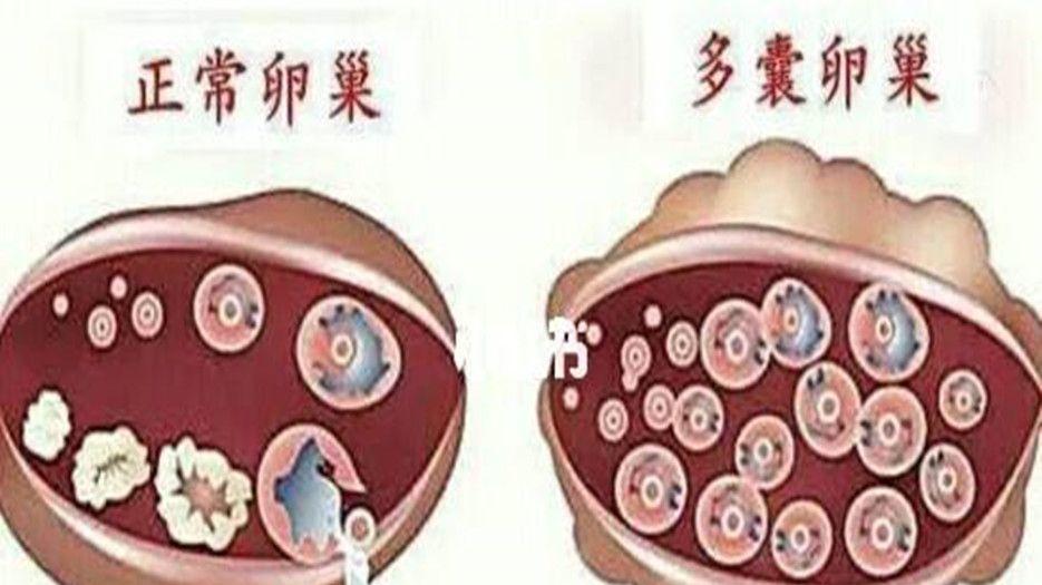 多囊卵巢名词科普