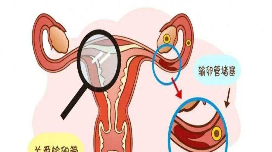 女性输卵管堵塞的原因和预防