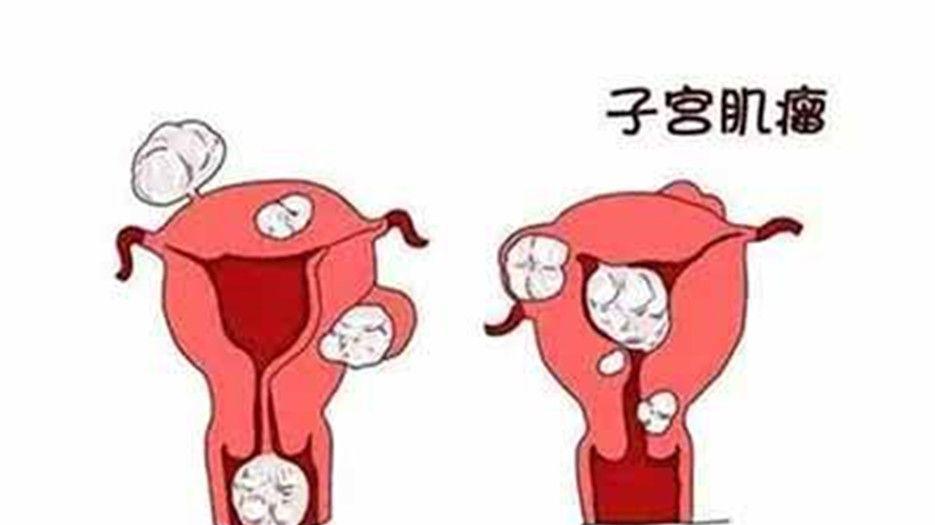 什么是子宫肌瘤