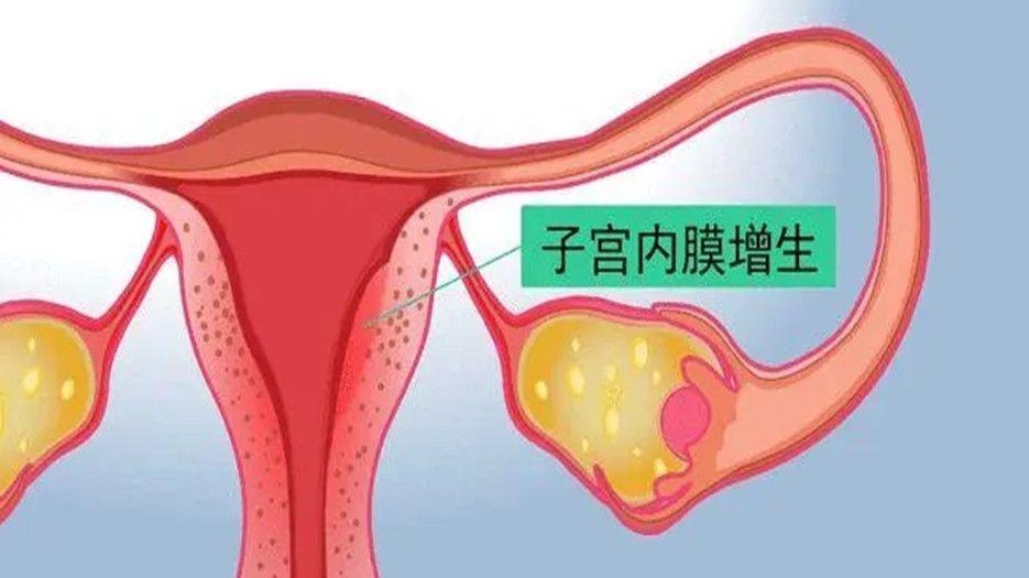 什么是子宫内膜增生