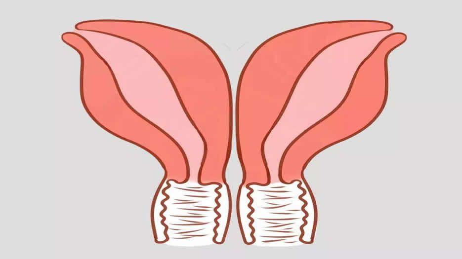 女性双角子宫