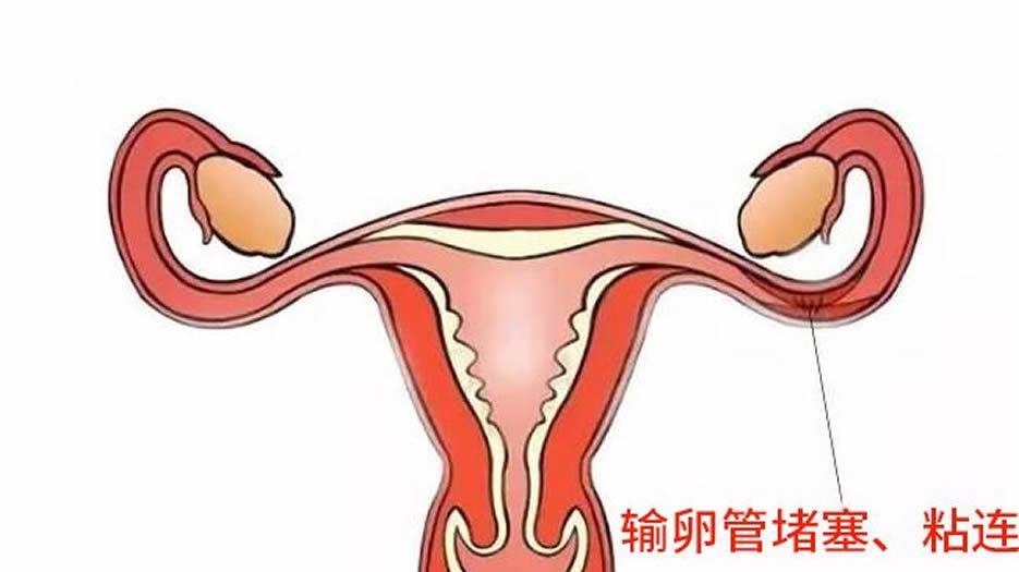 女性输卵管堵塞