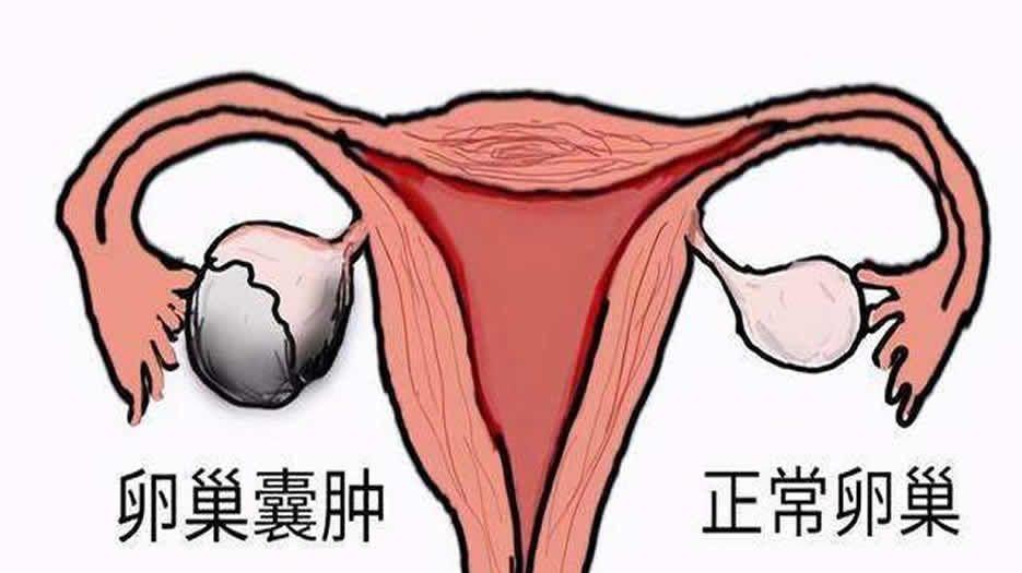 卵巢肿瘤