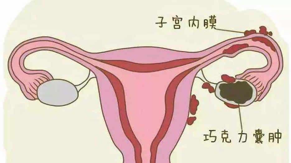 卵巢巧克力囊肿