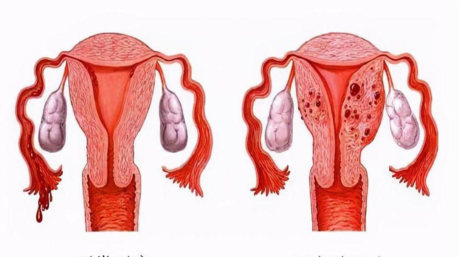 查出得了子宫腺肌症的人