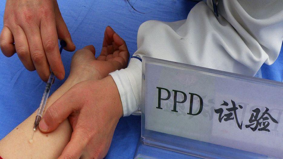 ppd试验强阳性