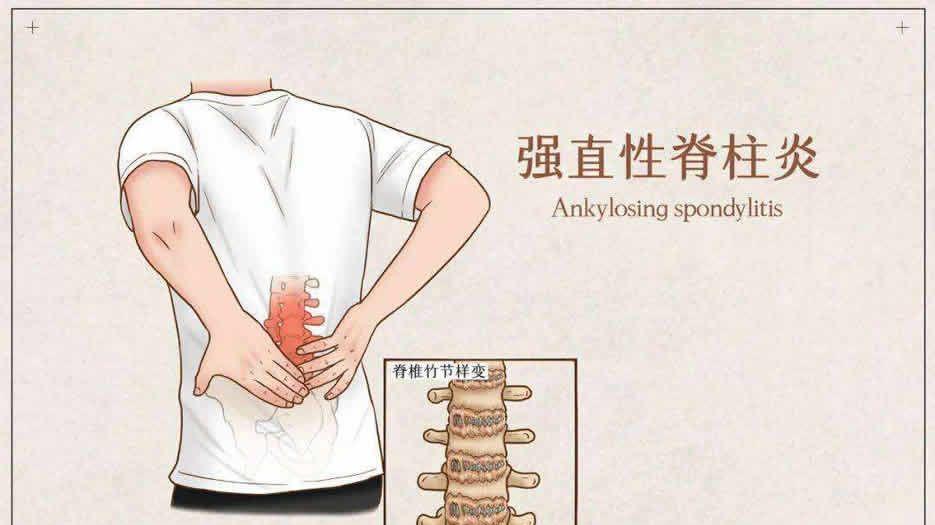 强直性脊柱炎.jpg