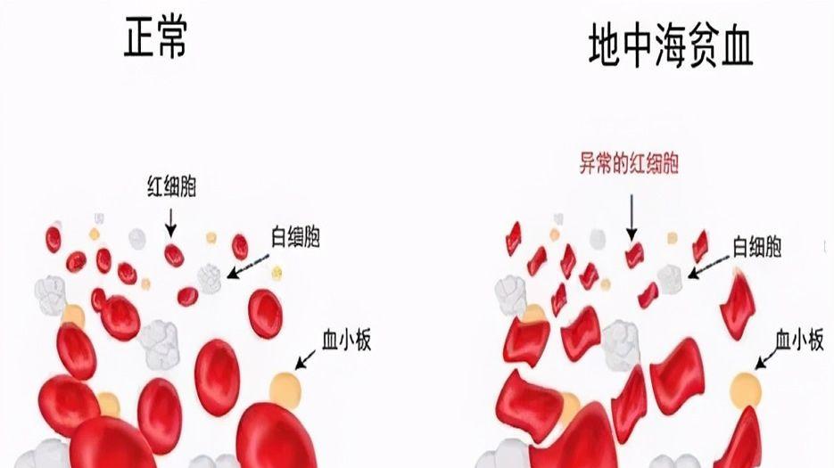 地中海贫血.jpg