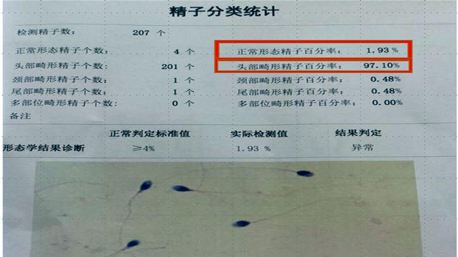 二代试管会剔除畸形精子吗？专家解读精子畸形做第几代试管 (14).jpg