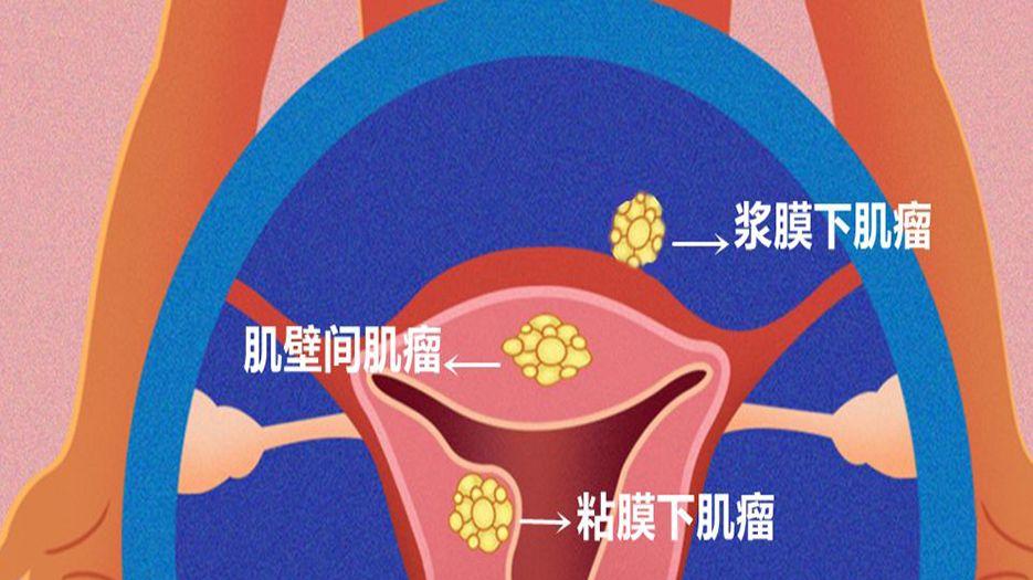 子宫肌瘤.jpg