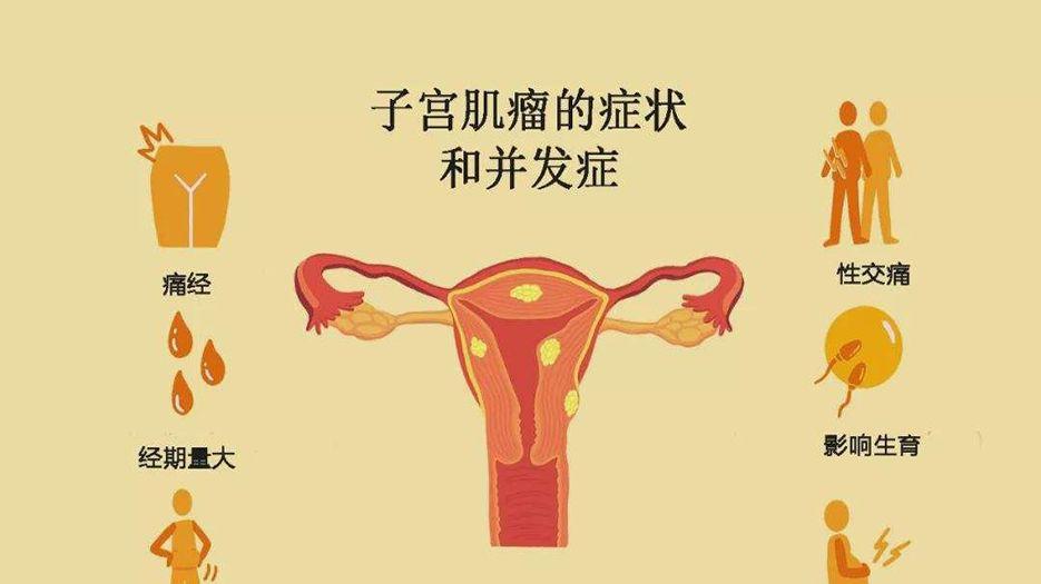 子宫肌瘤症状.jpg