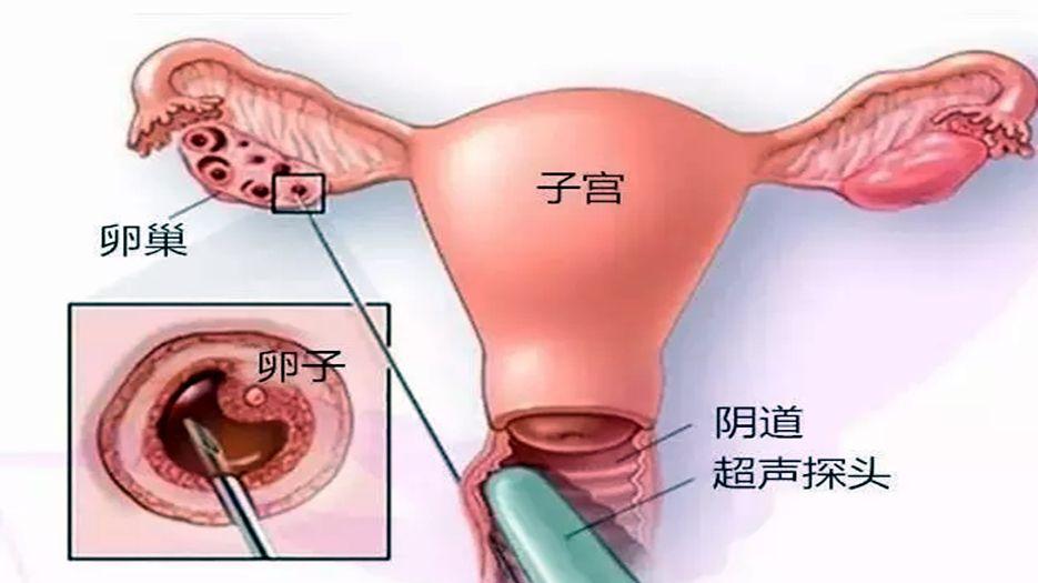 试管婴儿活体取卵是不是特别疼？专家解读试管婴儿女性取卵痛苦吗 (1).jpg