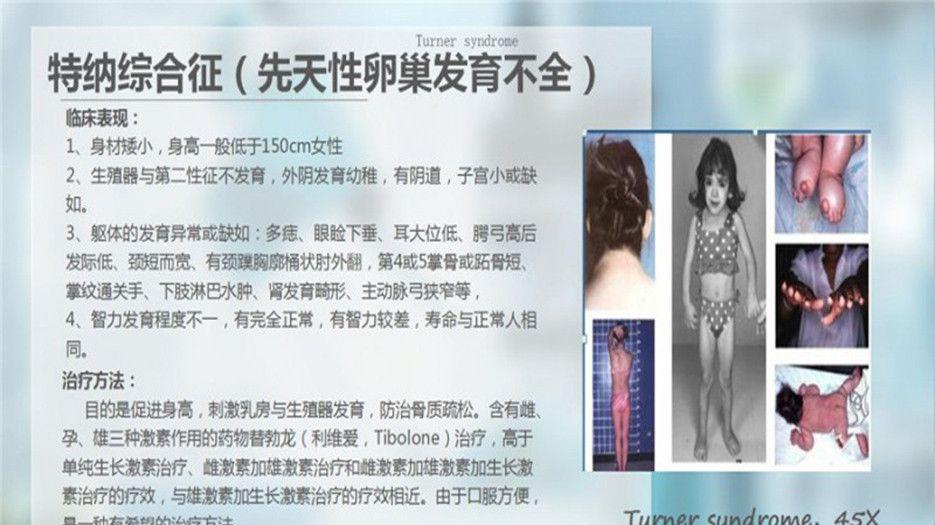 嵌合型特纳综合征_副本.jpg