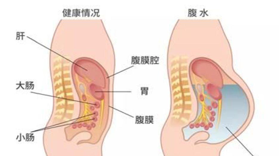 腹水..jpg