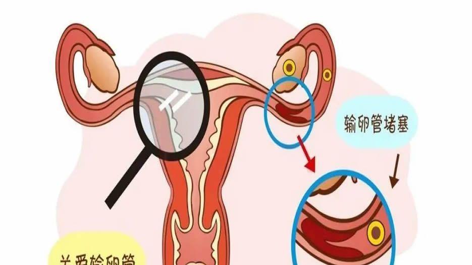 输卵管堵塞.jpg