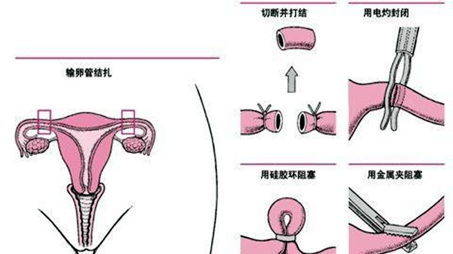 女性结扎10年还能做试管受孕吗？专家解答女性结扎10年了还能生孩子吗 (1).jpg