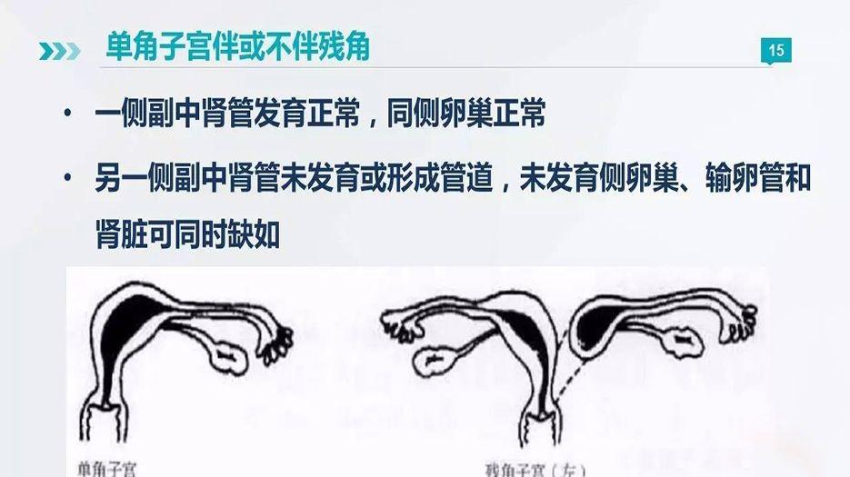 什么是单角子宫.jpg