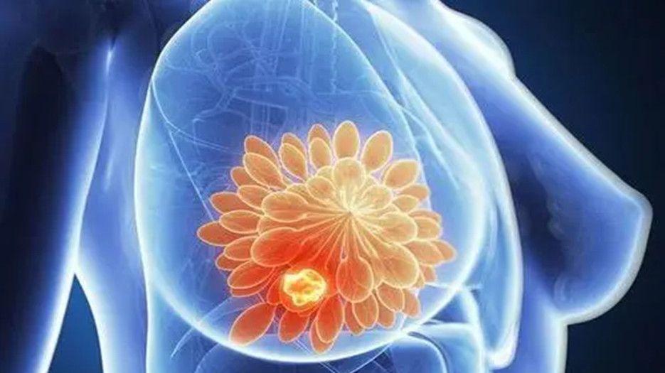 乳腺结节_副本.jpg