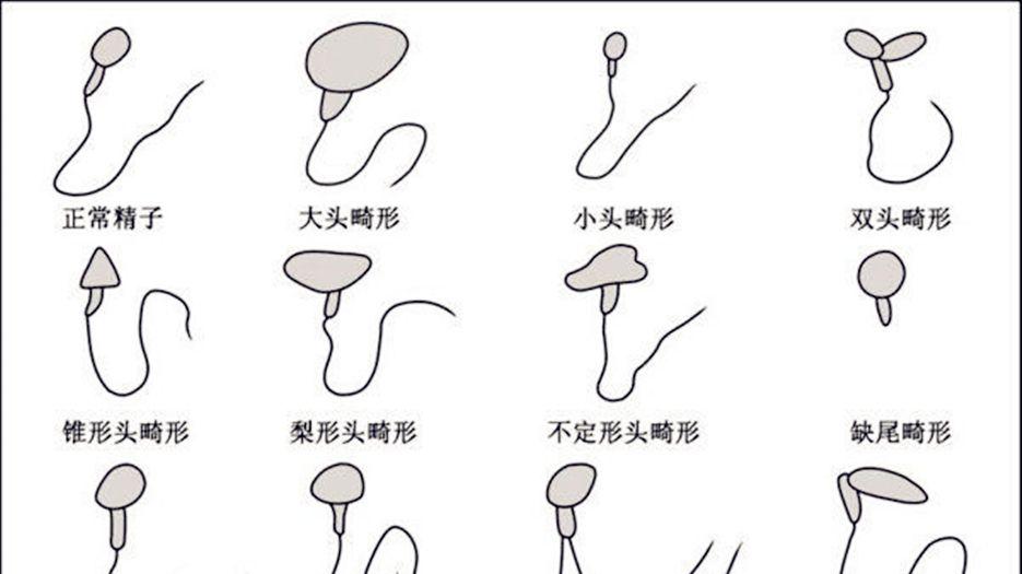 精子畸形率高还能做试管婴儿吗？专家解读精子畸形率高适合做几代试管 (1).jpg