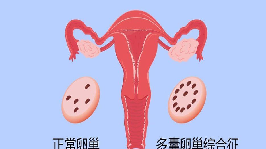 多囊卵巢