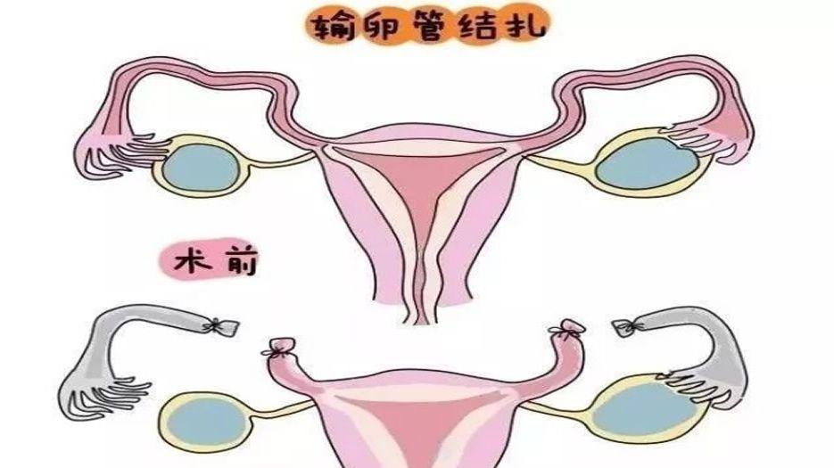 输卵管结扎