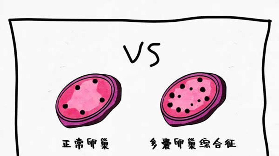 什么是多囊卵巢综合征（PCOS）