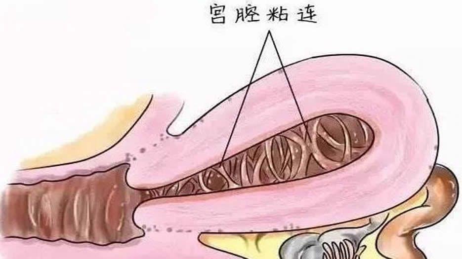 子宫疾病