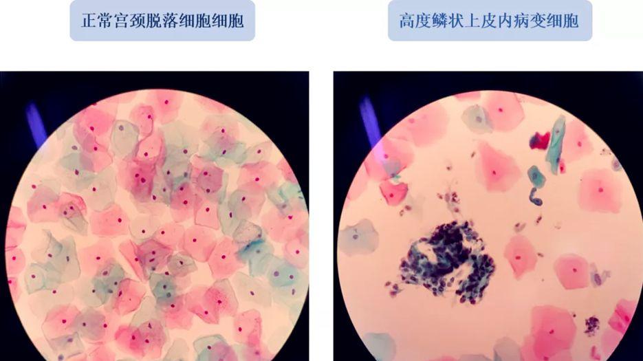 做试管婴儿可以筛查癌症？专家解读试管婴儿癌症基因筛查 (2).jpg