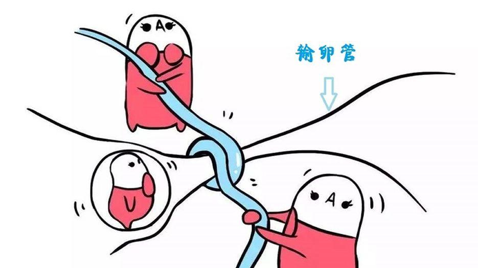 输卵管积水1.jpg