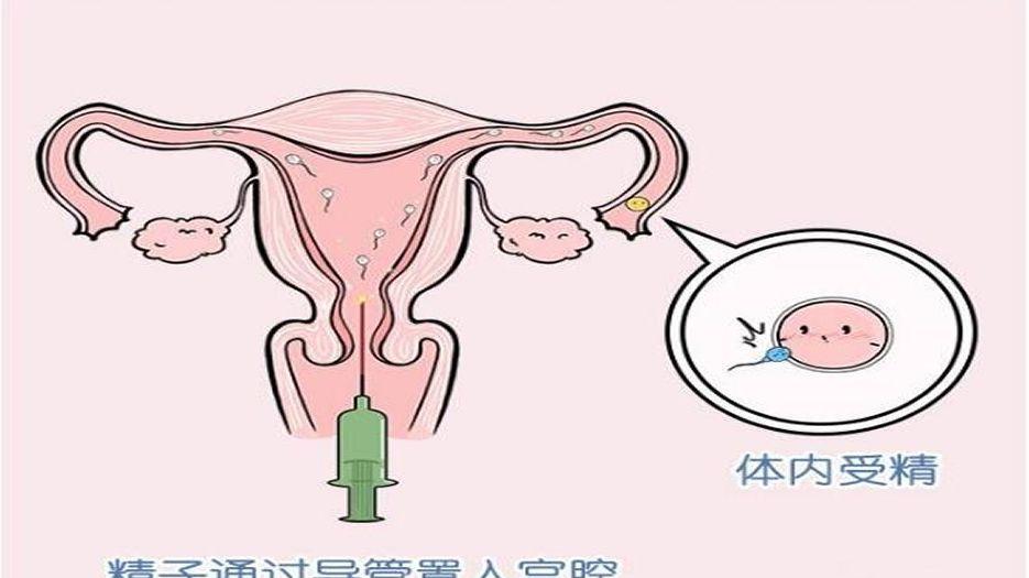 人工受精技术
