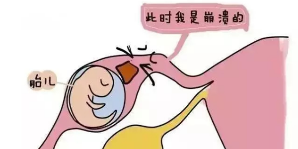 试管可以完全杜绝宫外孕吗？不能！但比自怀发生宫外孕的风险低！