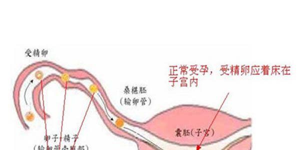 试管可以完全杜绝宫外孕吗？不能！但比自怀发生宫外孕的风险低！
