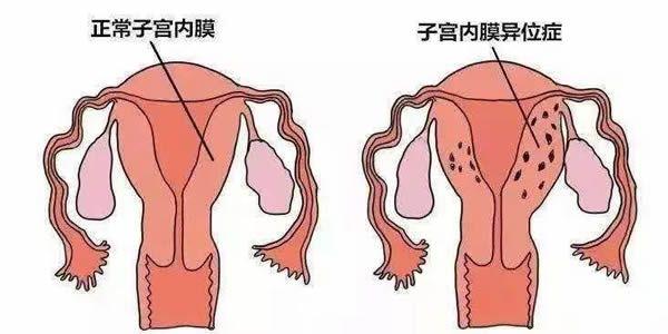 女性患有子宫内膜异位症影响做试管婴儿吗