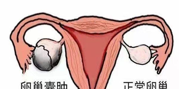 卵巢黄体囊肿会影响试管婴儿移植吗