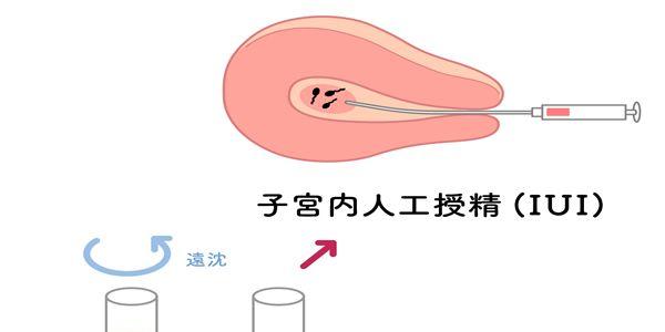 小蝌蚪找爸爸之人工授精如何优化精子
