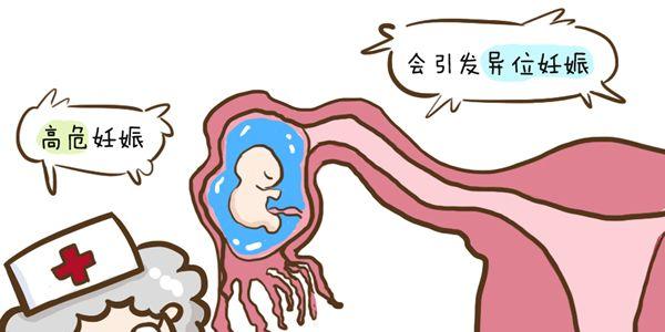 试管婴儿异位妊娠是怎么引起的