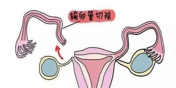 女性没有输卵管同样可以做试管婴儿当妈妈