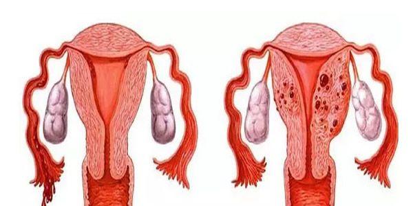 重度子宫腺肌症能做试管婴儿吗