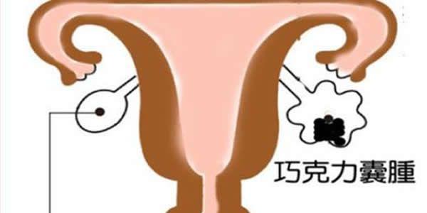 巧克力囊肿能做试管婴儿吗